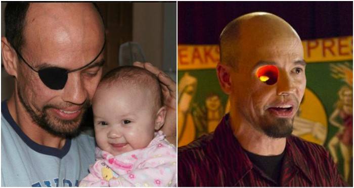 Billy Owen Eye: Inspiring Resilience After Face Cancer