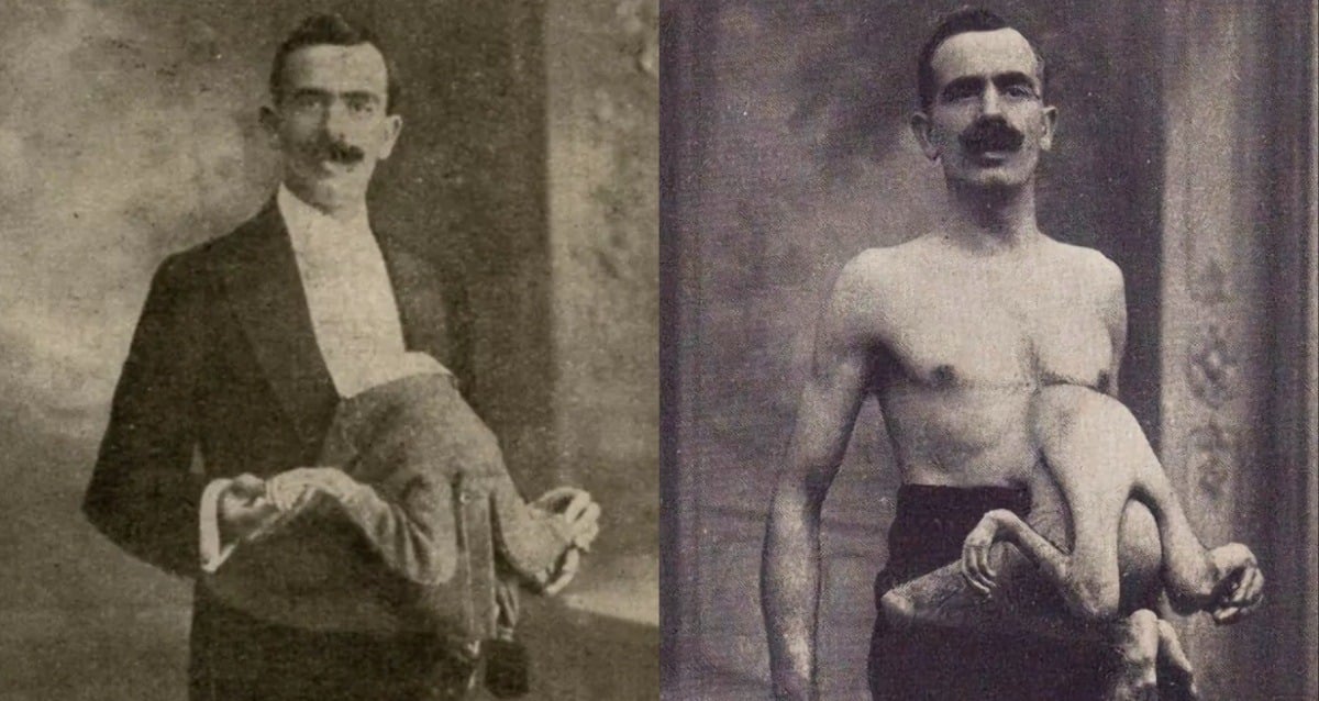 Jean and Jacques Libbera: The Fascinating Story of a Double-Bodied Man