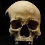 Archaeological close-up of a 14th-century human skull showing evidence of nasal amputation