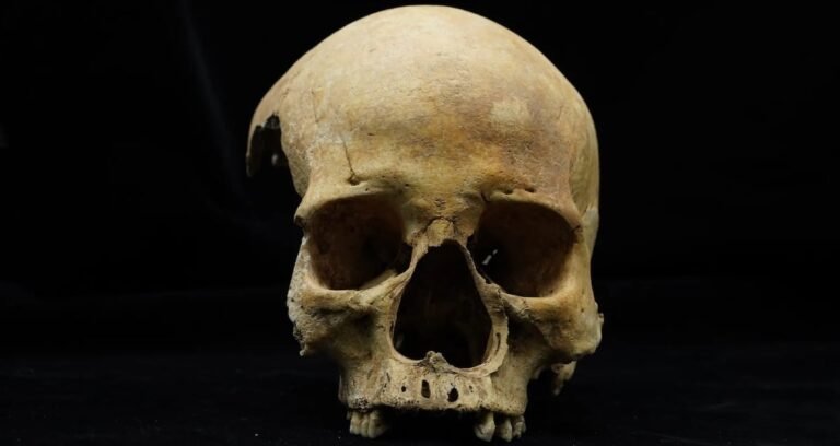 Archaeological close-up of a 14th-century human skull showing evidence of nasal amputation